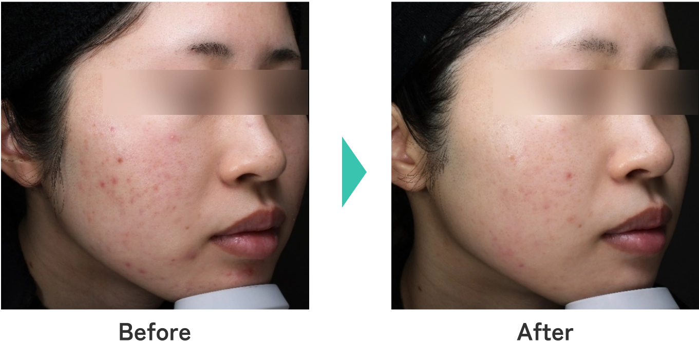 軽症ニキビ治療のBefore/After