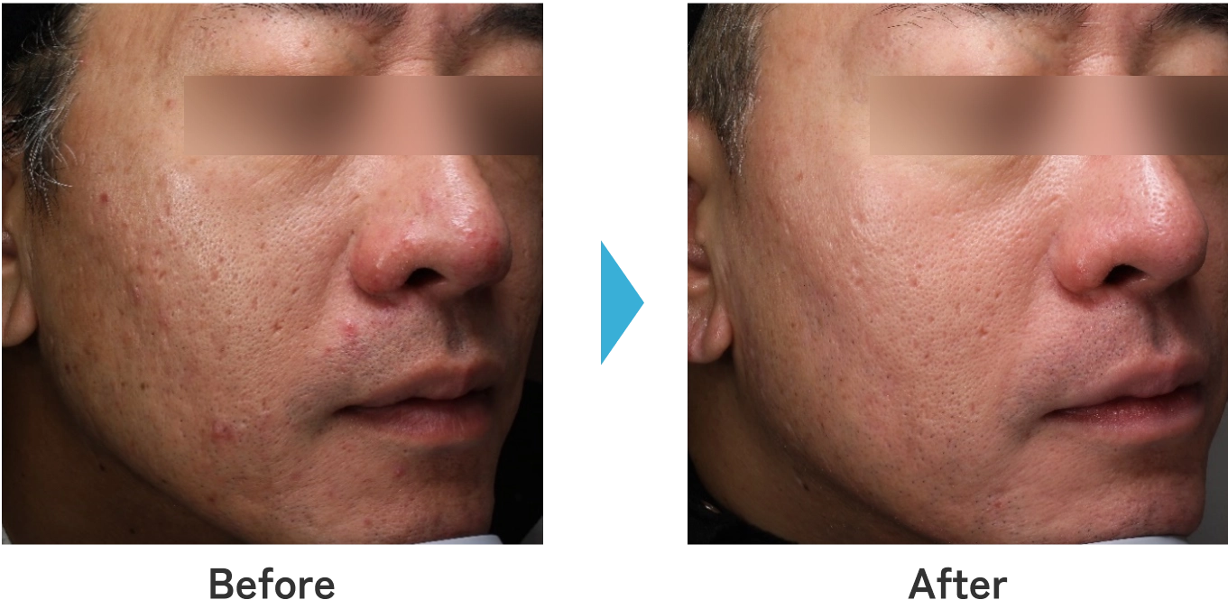 ニキビ跡治療のBefore/After